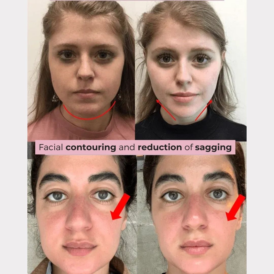 V-LiftUp – Korean Contour Mask for a Firmer, Youthful Face